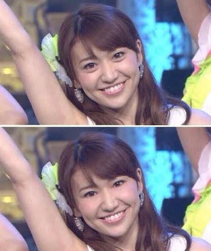 涙袋 ビフォーアフター 画像