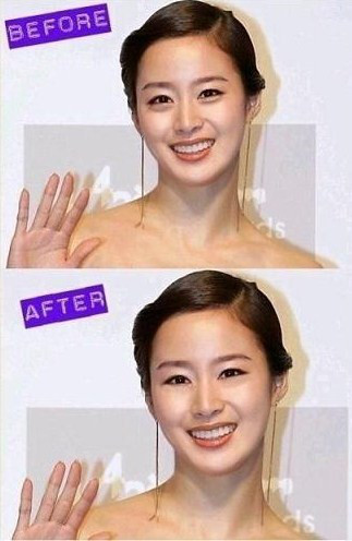 涙袋 ビフォーアフター 画像